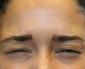 3 Days After Botox