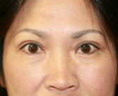 After Double Eyelid Surgery After Double Eyelid Surgery