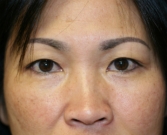 Before Double Eyelid Surgery