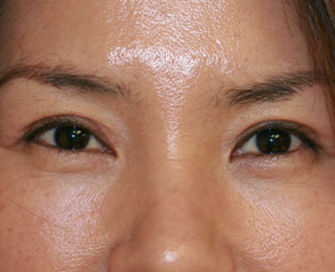 After Double Eyelid Surgery