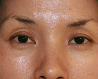 Before Double Eyelid Surgery