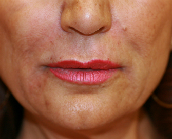 Nasolabial Folds Immediately After Juvederm Filler-smile-lines-juvederm-nasolabial-folds-after-san-diego-plastic-surgeon