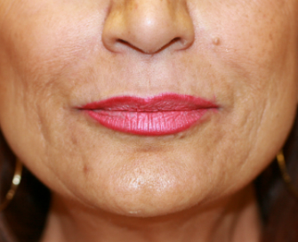Nasolabial Folds Before Juvederm Filler-smile-lines-nasolabial-folds-before-san-diego-plastic-surgeon