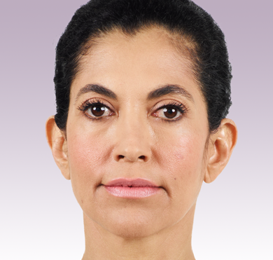 Before Juvederm Liquid Facelift San Diego Plastic Surgeon 