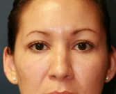 After Double Eyelid Surgery