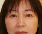 After Double Eyelid Surgery