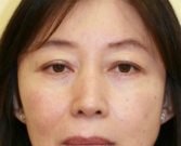 Before Double Eyelid Surgery
