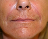 Nasolabial Folds Immediately After Hyaluronic Filler Filler-smile-lines-nasolabial-folds-after-san-diego-plastic-surgeon