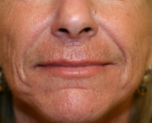 Nasolabial Folds Before Hyaluronic Filler Filler-smile-lines-nasolabial-folds-before-san-diego-plastic-surgeon