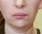 Nasolabial Folds After Juvederm Filler-smile-lines-nasolabial-folds-after-san-diego-plastic-surgeon