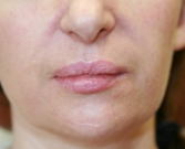 Nasolabial Folds Before Juvederm Filler Filler-smile-lines-nasolabial-folds-before-san-diego-plastic-surgeon
