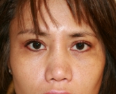 After Double Eyelid Surgery