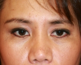 Before Double Eyelid Surgery