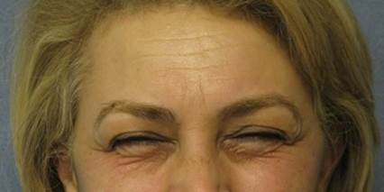 Permanent Botox Up to 2 years, ThermiSmooth Treatment, Frown Lines After
