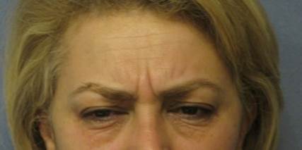 Permanent Botox Up to 2 years, ThermiSmooth Treatment, Frown Lines Before