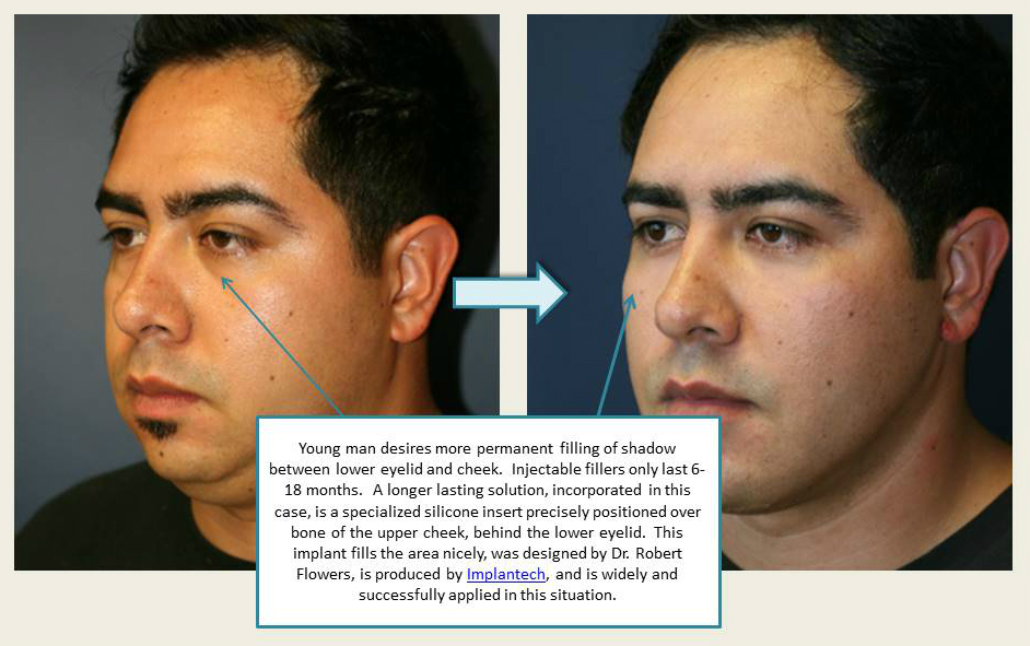 Young man desires more permanent filling of shadow between lower eyelid and cheek. Injectable fillers only last 6-18 months. A longer lasting solution, incorporated in this case, is a specialized silicone insert precisely positioned over bone of the upper cheek, behind the lower eyelid. This implant fills the area nicely, was designed by Dr. Robert flowers, is produced by Implantech, and is widely and successfully applied in this situation.