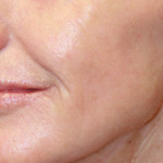 After Healing From Laser Treatment of Cheek Skin