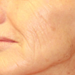 Before Laser Treatment of Cheek Skin