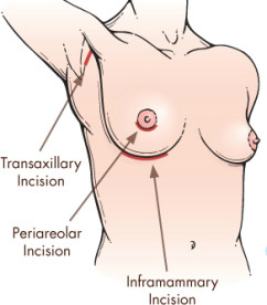 Breast Augmentation Scar Location