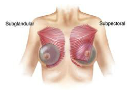 subdermal implant chest