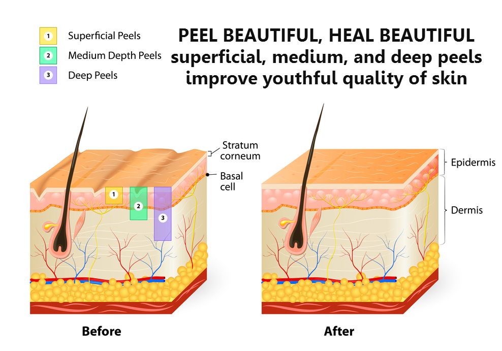 skin-peels-chemical-peel-expert-peels-san-diego