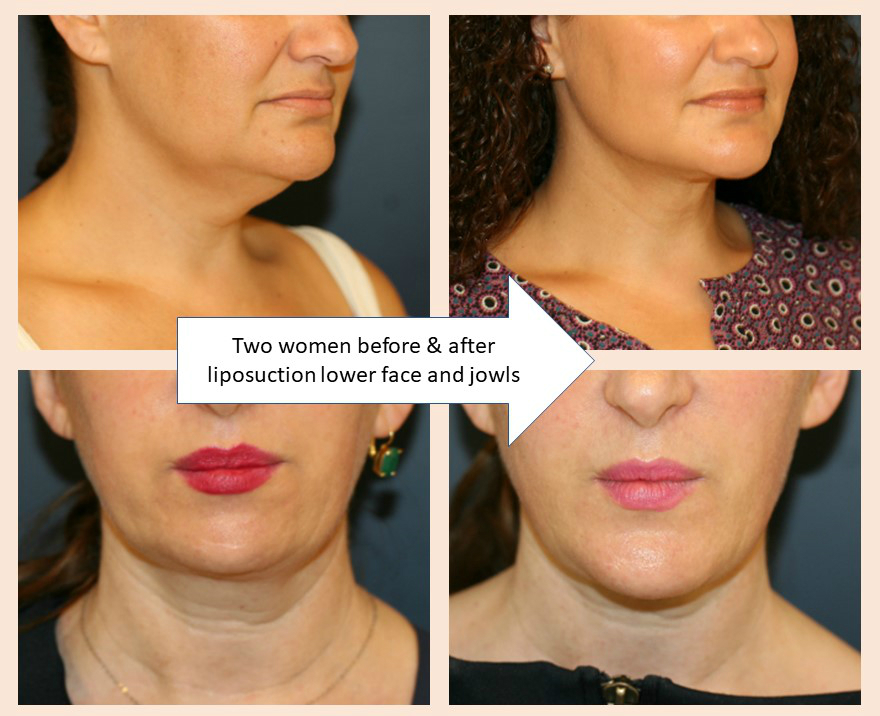 Two women before and after liposuction lower face and jowls
