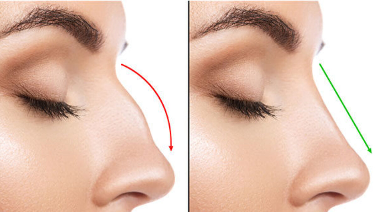 Nose Job: Yes or No? - Feel Beautiful San Diego