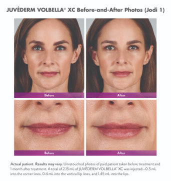 Juvederm San Diego, Dr. Steve Laverson - Feel Beautiful