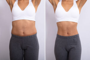 tummy tuck before and after gallery GettyImages 1094155426