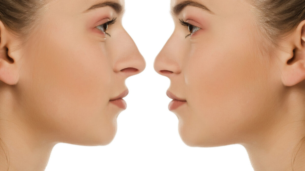Open Vs. Closed Rhinoplasty