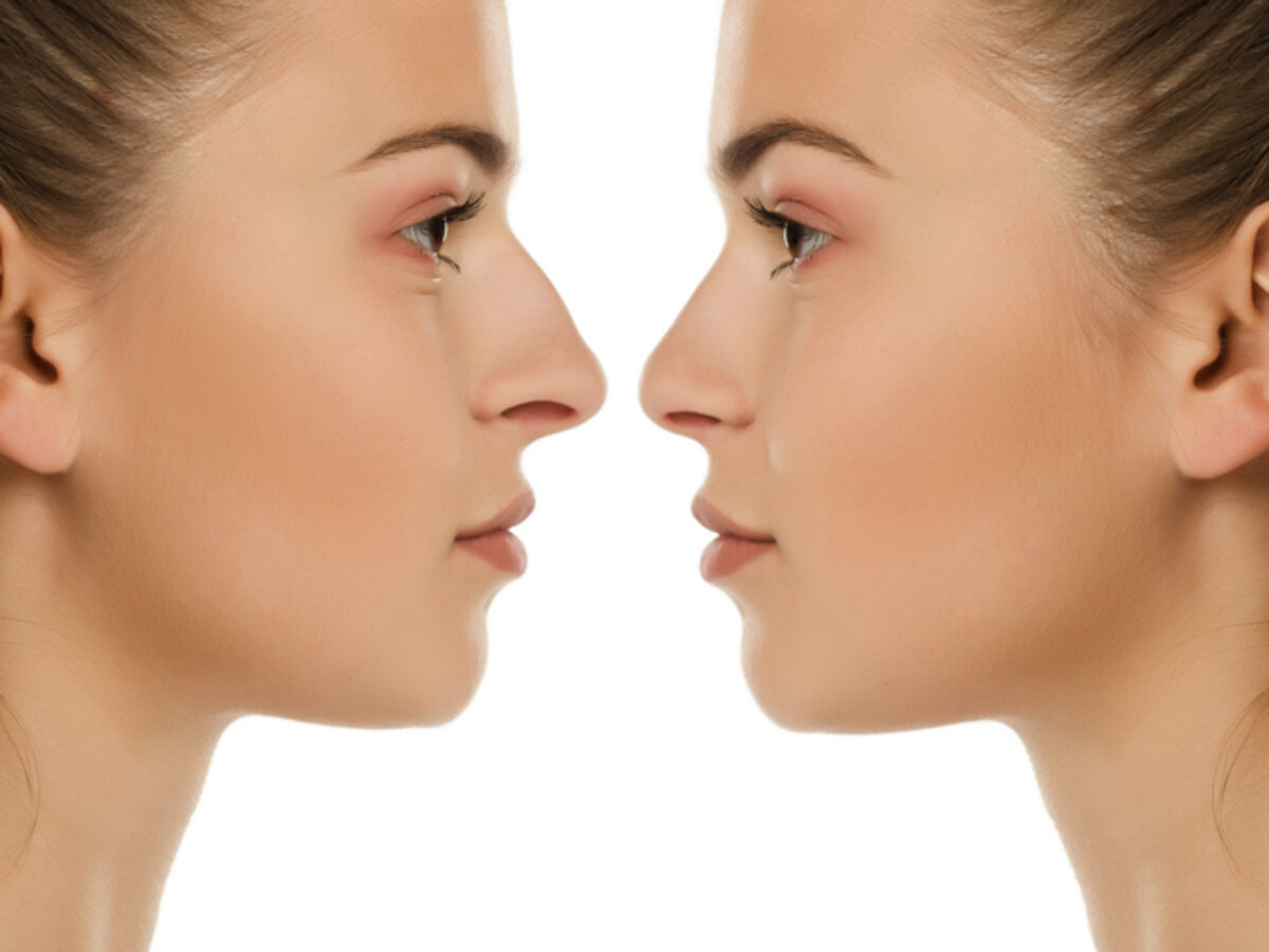 健康・医学 Closed rhinoplasty 健康・医学 Preservation Rhinoplasty