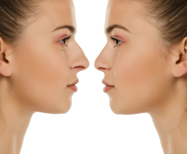 Comparison portrait of same woman before and after nose surgery on white background