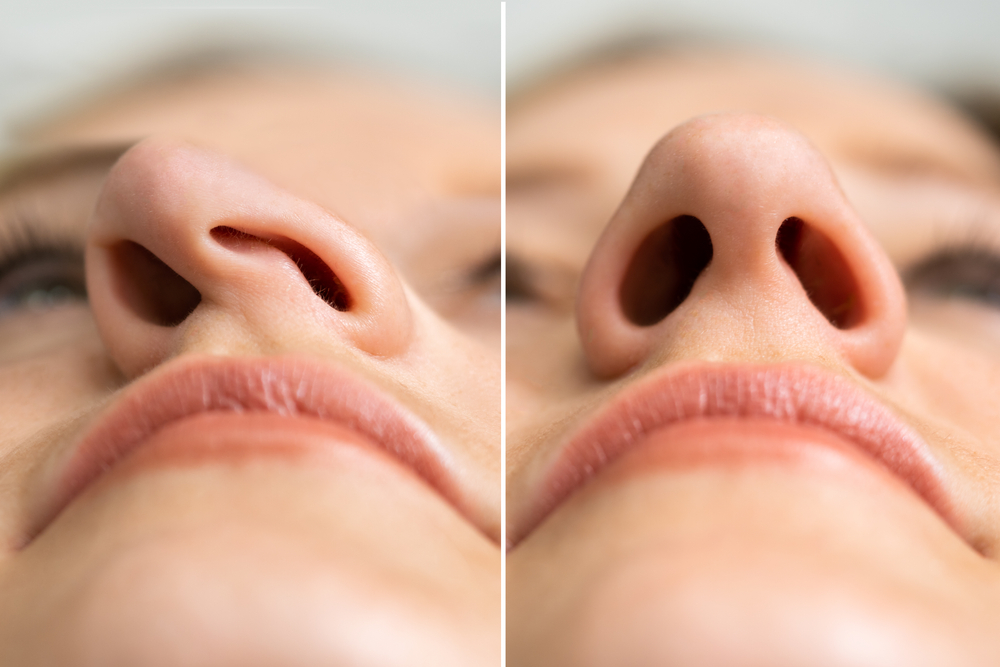 Before,After,Young,Woman,Aesthetic,Facelift.,Rhinoplasty,Nose,Surgery
