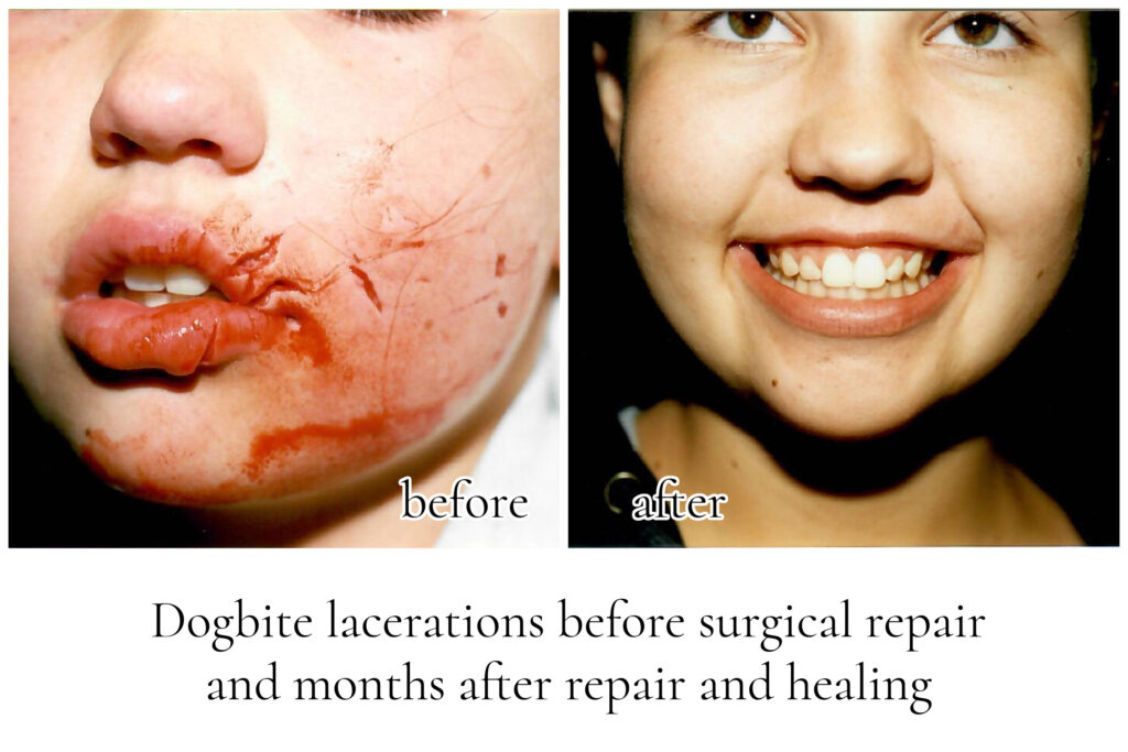 Dogbite laceration repairs before and after plastic surgery san diego