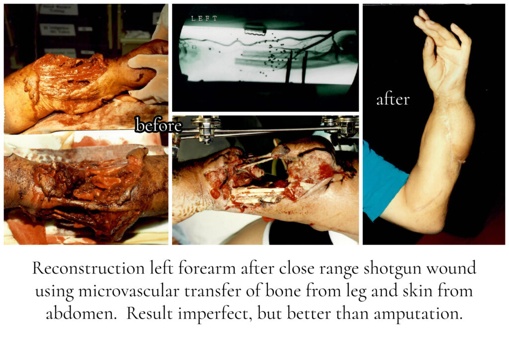 Forearm Reconstruction Excellent Outstanding San Diego Plastic Surgeon