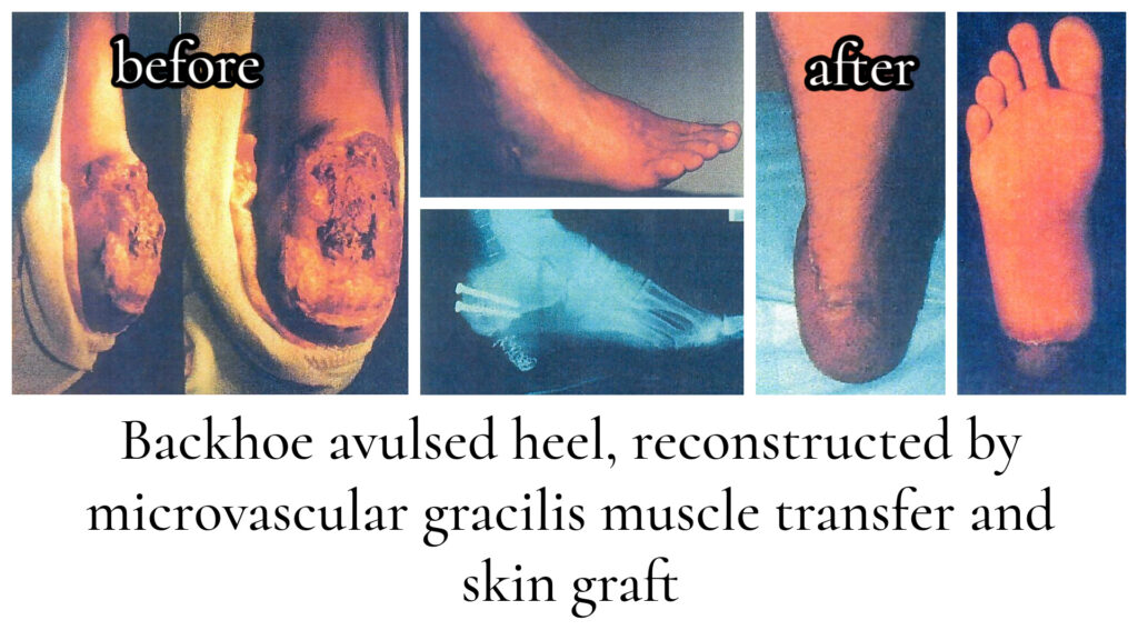 Heel Reconstruction Amazing Plastic Surgery San Diego