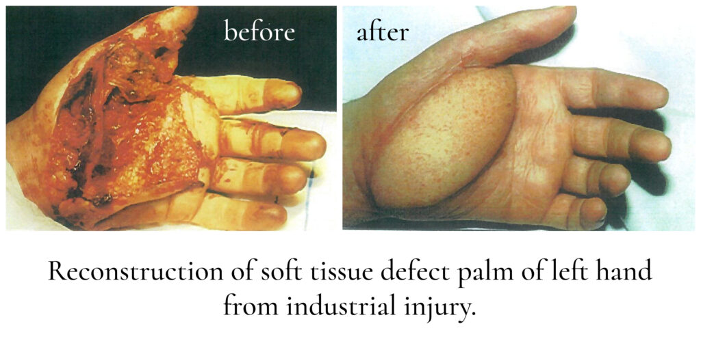 Reconstruction Palmar Defect Feel Beautiful Plastic Surgery Wizard