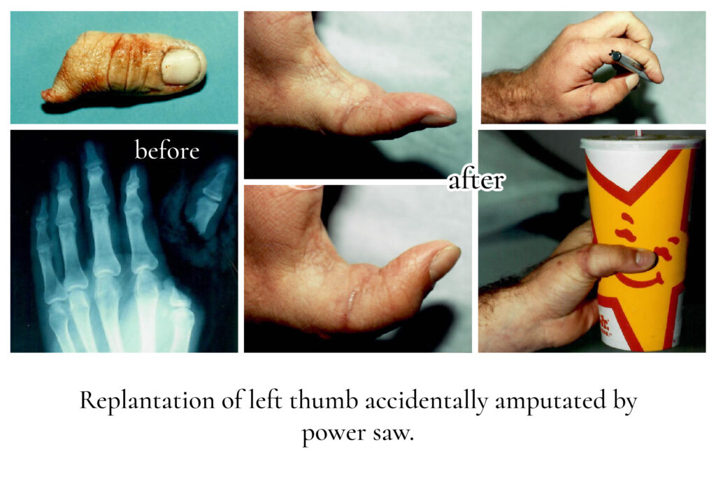 Replantation of thumb Dr. Steve Laverson Plastic Surgery San Diego