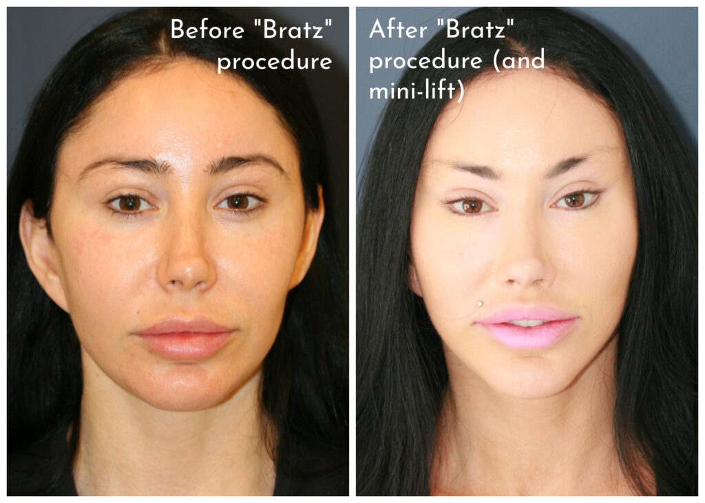 Bratz Blepharoplasty