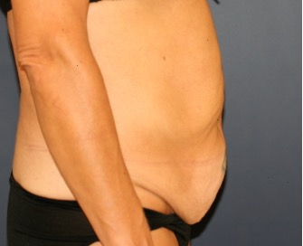 Tummy Tuck 203 C