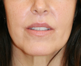 corner lip lift patient after