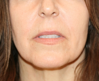 corner lip lift patient