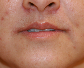 corner lip lift sad to pleasant after