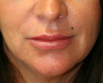 lip augment san diego 10 after