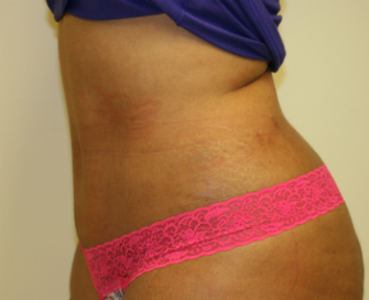 tummy tuck san diego best side post