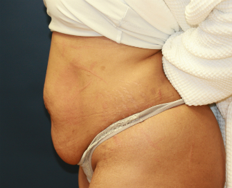 tummy tuck san diego best side pre (1)