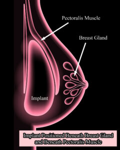 Breast Implant Under the Muscle Subpectoral Submuscular Dual Plane Submuscular Breast Augmentation