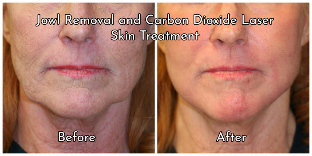 Jowl Removal Before and After San Diego