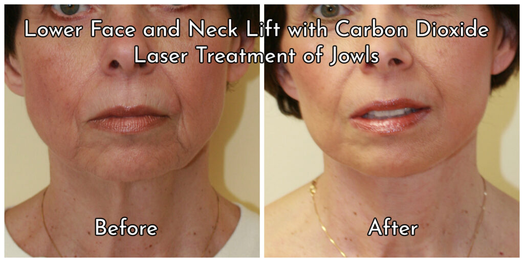 Jowls before and after (1)
