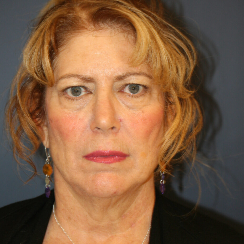 facelift1before